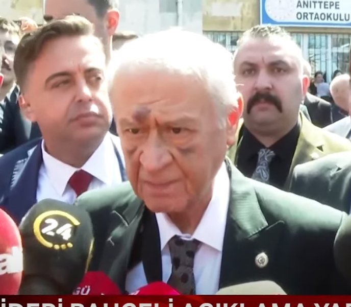 Devlet Bahçeli Yüzü Mor Kolu Sargılı