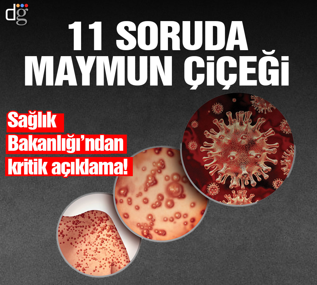 Ankara'da maymun çiçeği iddiası! Sağlık Müdürlüğü'nden açıklama